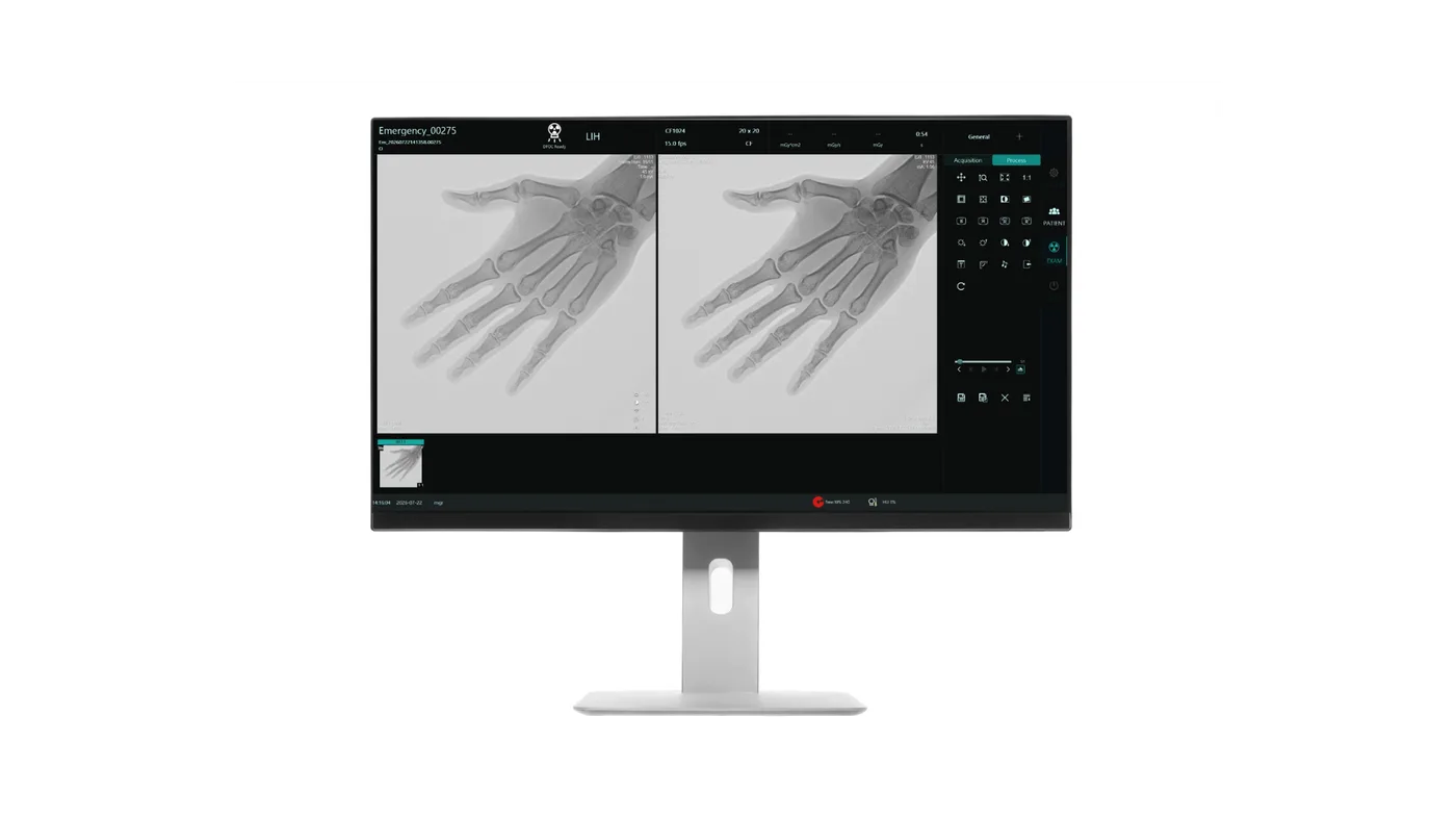 Fluoroscopy software on the C-arm display