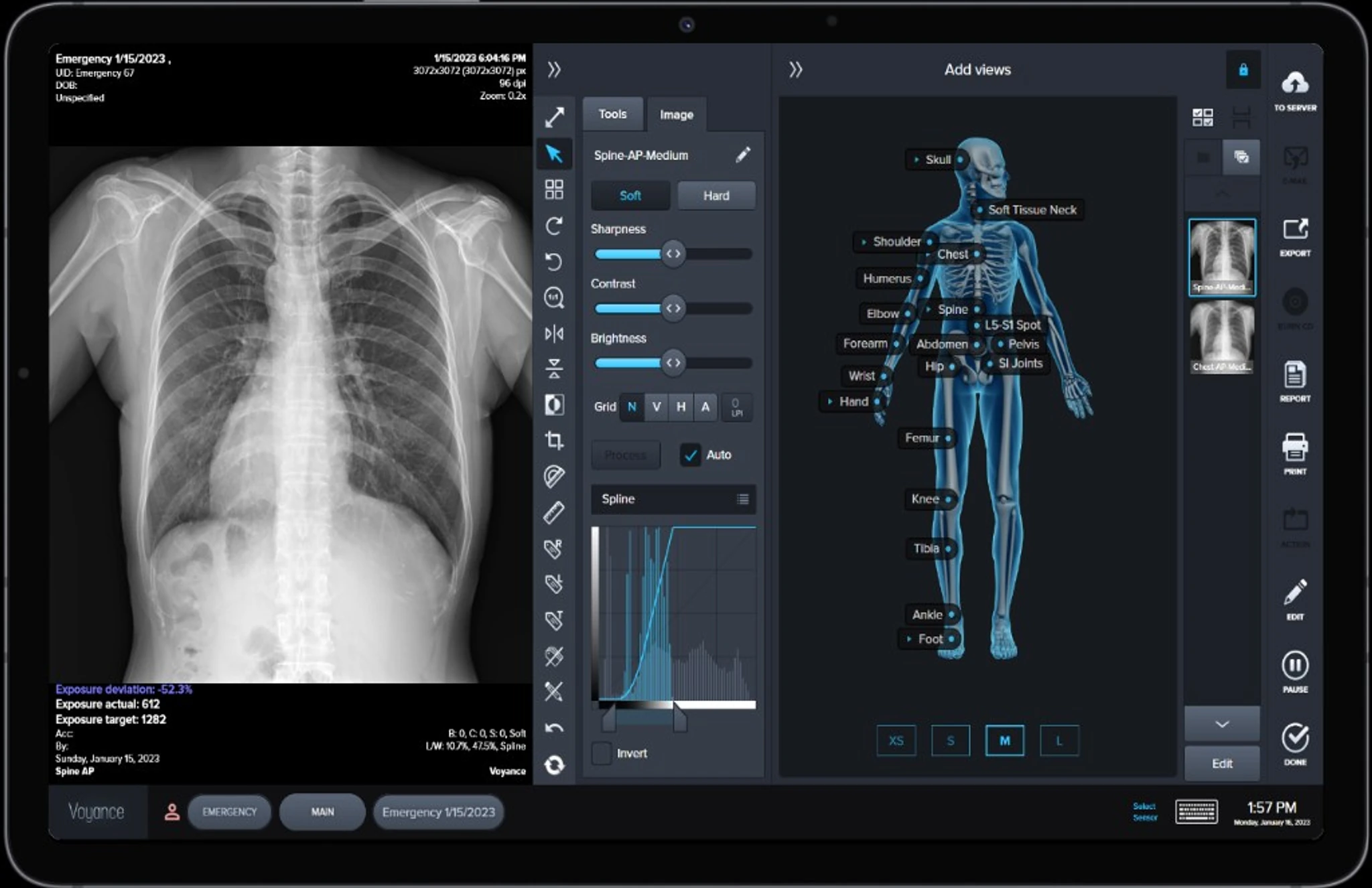 VoyanceX contrast, noise cancellation, crop and grid-line suppression