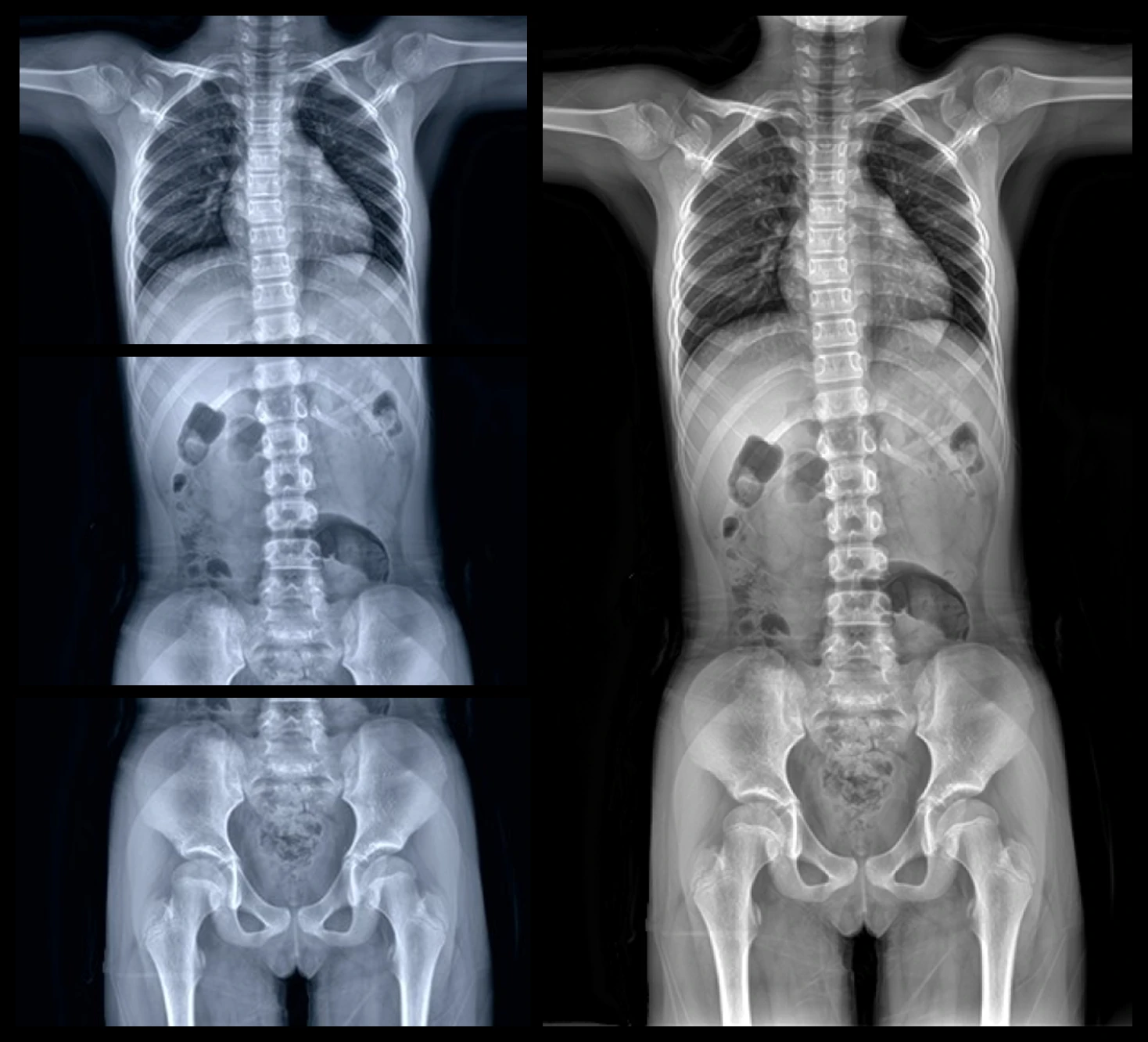 Chest, abdomen and pelvis films beside the stitched whole-spine view